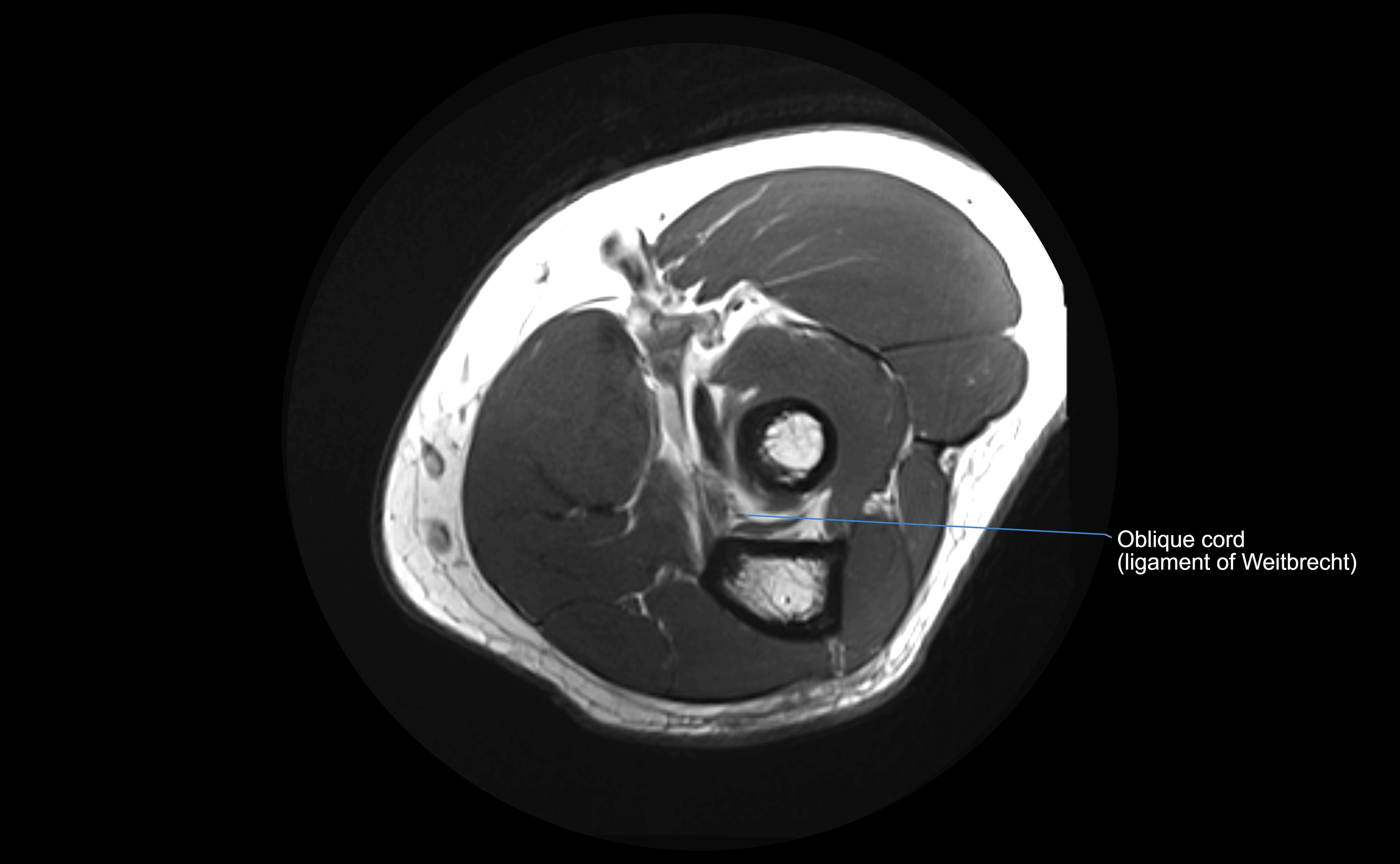 MRI elbow ligaments axial cross sectional anatomy 3T  radiology  image-img-00001-00022.webp